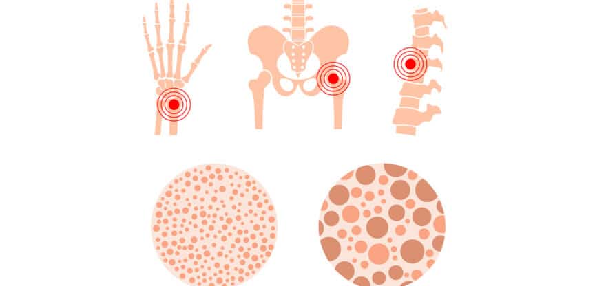 Knochenmasse, Osteoporose, neuen Therapieform