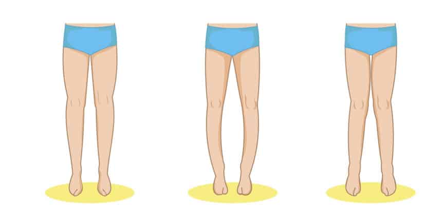Fehlstellung, Knie, Bein, O-Beine, X-Beine
