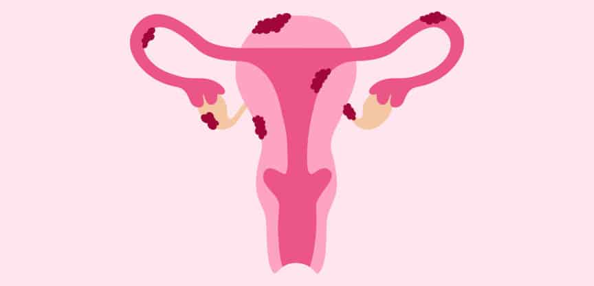 Gebärmutterschleimhaut, Endometriose, Menstruationsschmerzen