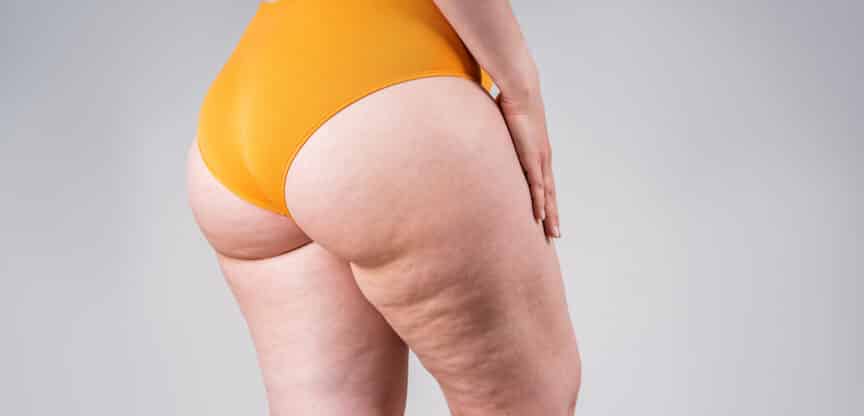 Cellulite Bindegewebe Straffen Sport