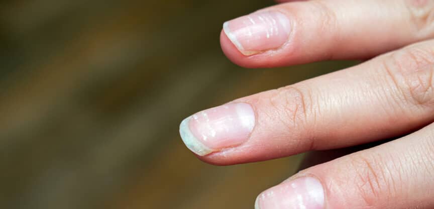 Nagelgesundheit Nagelpilz Mangel Biotin