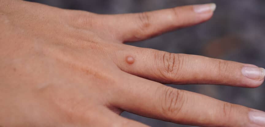 Behandlungsmethoden Warzen HPV