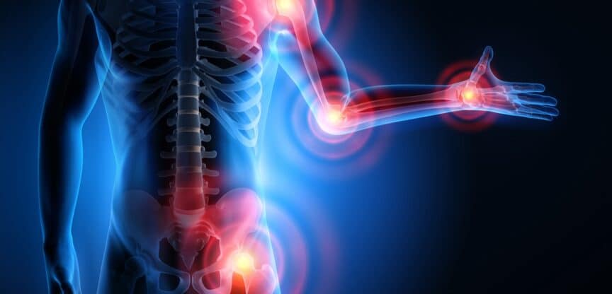 Arthritis Polyarthritis Schwellungen