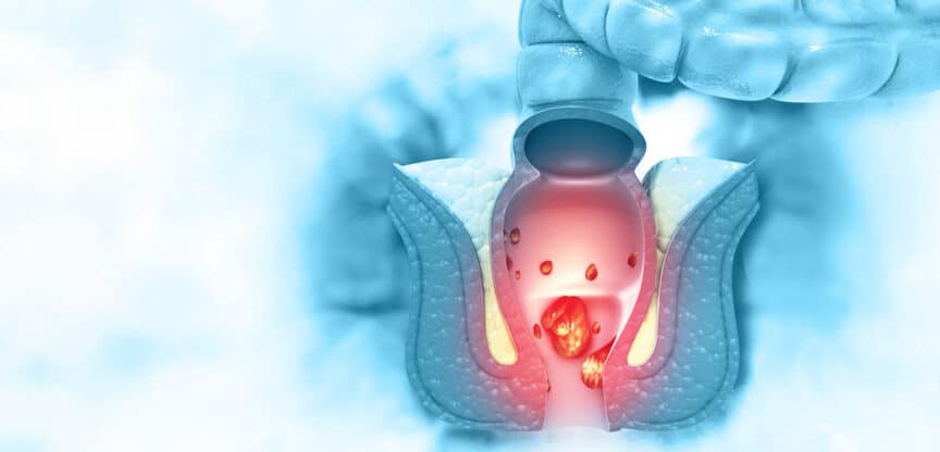 Anal- und Enddarmbereich, Hämorrhoiden, Abszesse, Ekzeme, Fissuren