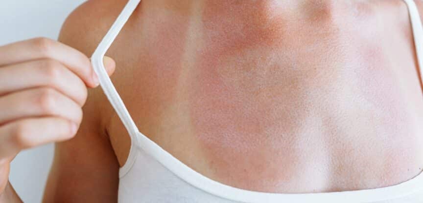 Sonnenbrand Sonnenallergie Hautkrebs