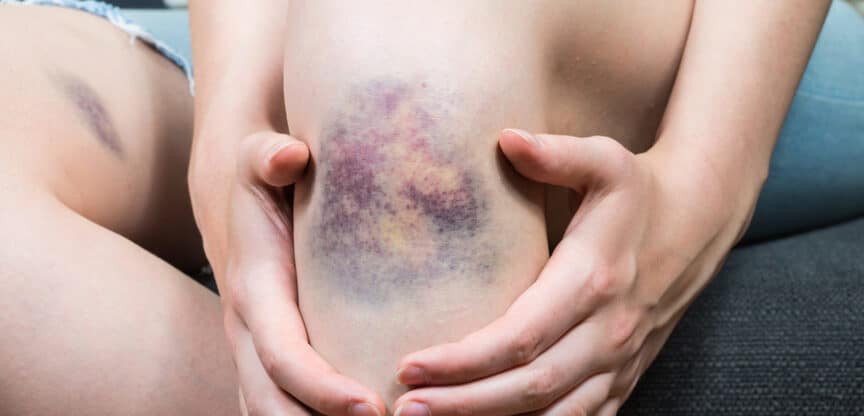 Bluterguss, Hämatom, blauer Fleck