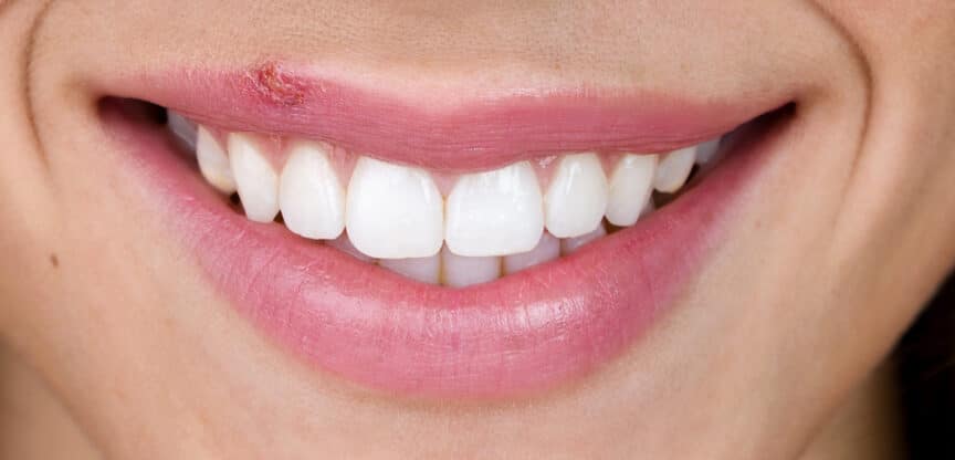 Lippenherpes HSV1 Erreger