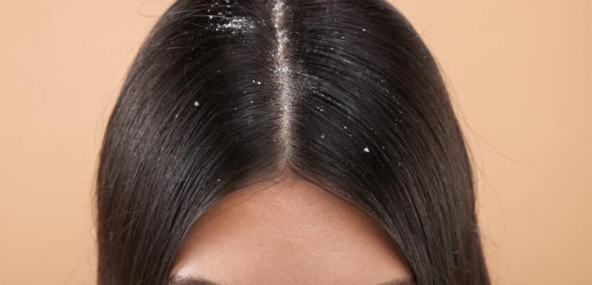 Schuppenshampoo Hautkrankheiten Talgdrüsen