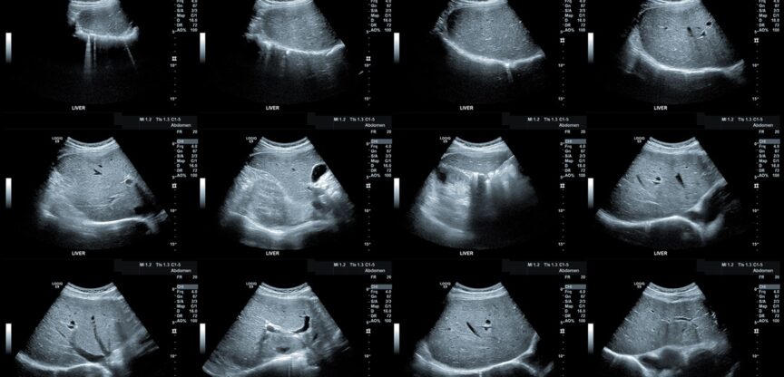 Leber, Blutbild, Leberwerte, Ultraschall