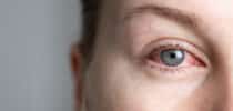 Rötung Augen Entzündungen