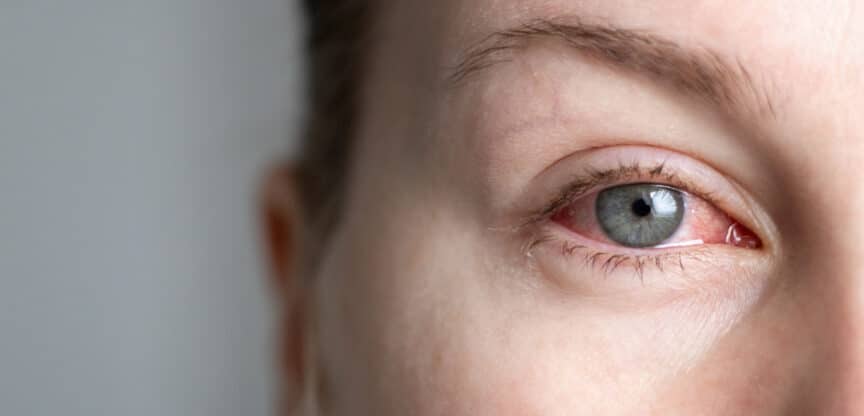 Rötung Augen Entzündungen