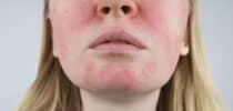 Rötungen Couperose Äderchen Schwellungen