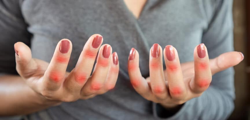 Gelenke, Polyarthritis, Polyarthrose, Gicht, Arthritis