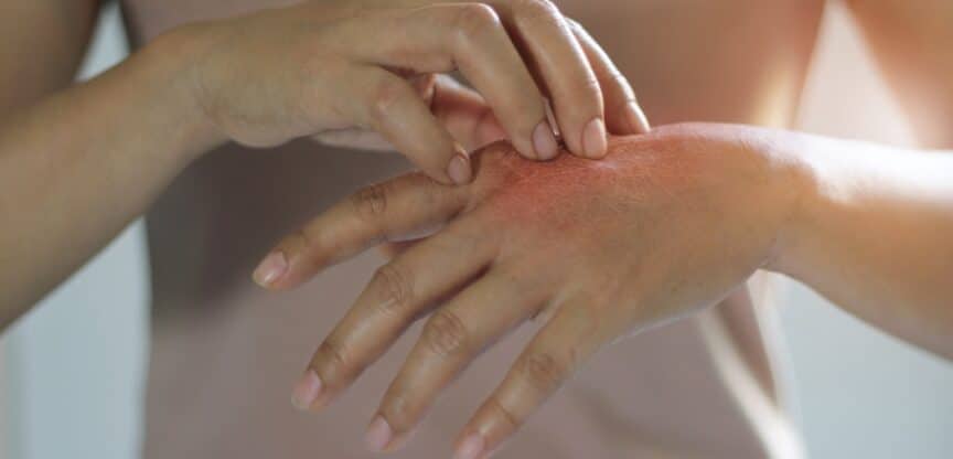 Schuppenflechte Psoriasis Beschwerden