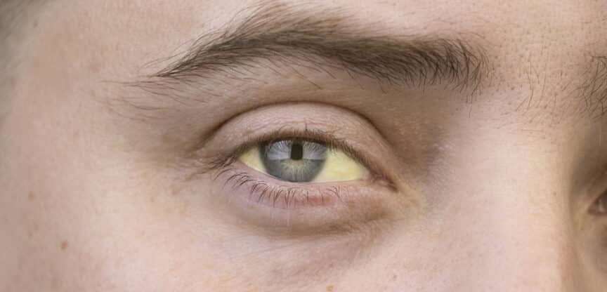 Galle, Gallenflüssigkeit, Fettverdauung