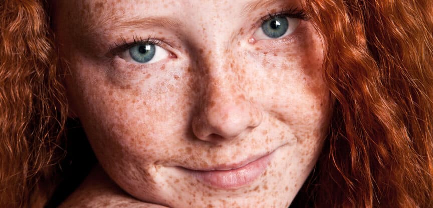 Hautveränderungen Muttermale Sommersprossen Pigmente