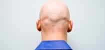 Ursachen und Behandlung Haarausfall Glatze