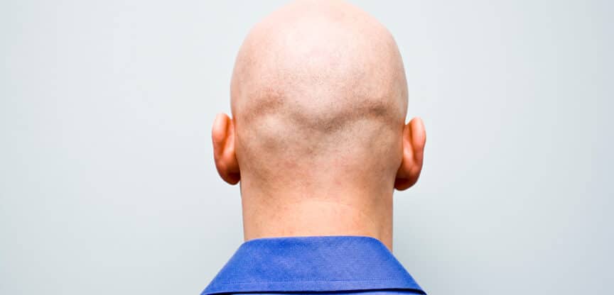 Ursachen und Behandlung Haarausfall Glatze