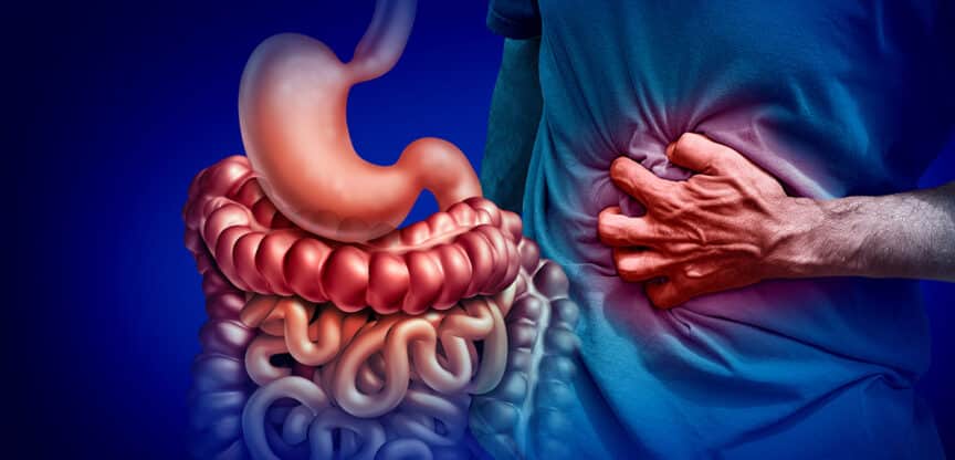 chronisch entzündliche Darmerkrankung, Morbus Crohn, künstlicher Darmausgang