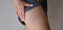 Behandlung Narben Fieberblasen Couperose