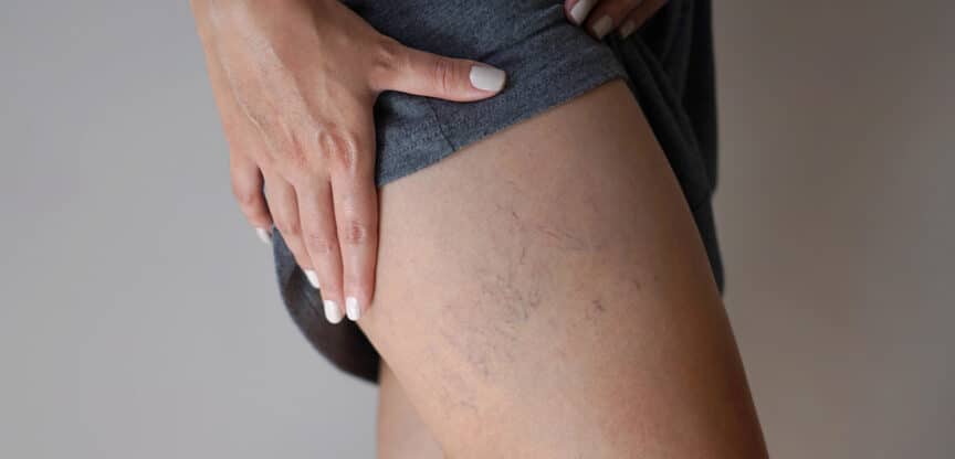 Behandlung Narben Fieberblasen Couperose
