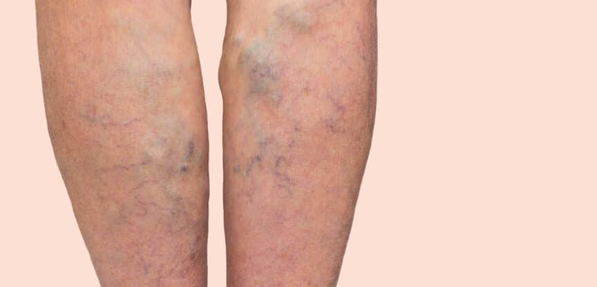 Krampfadern Venenleiden Kompressionstherapie