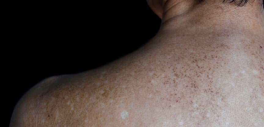 Hautveränderung Flecken Pusteln