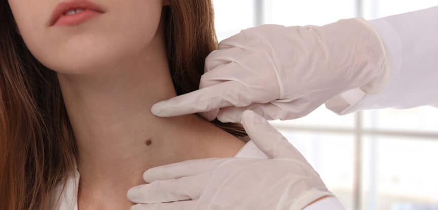 Muttermalkontrolle Hautkrebs Selbstcheck