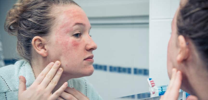 Problemhaut Pflege Talgdrüsen Feuchtigkeit T-Zone