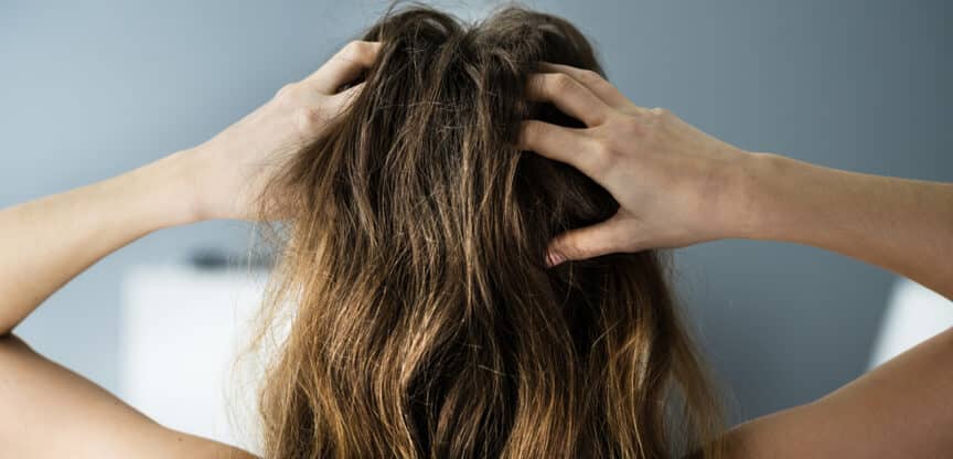 Kopfhaut Schuppen Fettige Kopfhaut Haarausfall