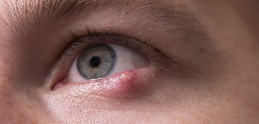 Augen, Bindehautentzuendung, Gerstenkorn, geschwollene Augenlider