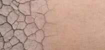 Hauterkrankungen. Schuppenflechte Neurodermitis Ichthyosis