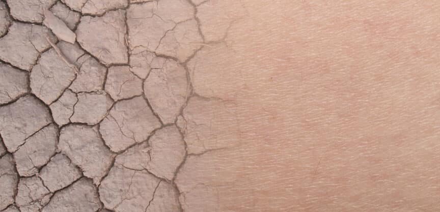 Hauterkrankungen. Schuppenflechte Neurodermitis Ichthyosis