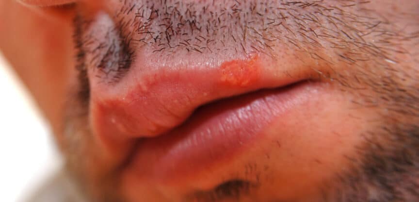 Herpesviren, Fieberblasen, Gürtelrose, Lungenentzündung