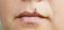 Piercingnarben