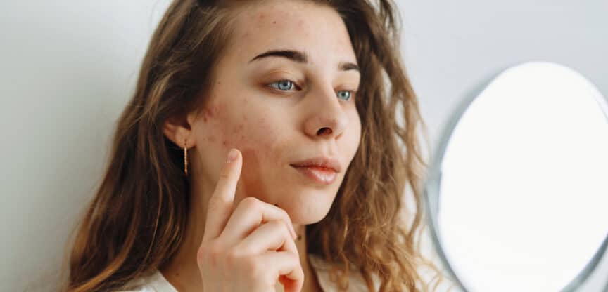 Akne Schuppenflechte Anti Stress