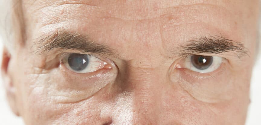 Augen, Allergien, Bindehautentzündung, Grauer Star, Grüner Star, Makuladegeneration, trockenes Auge