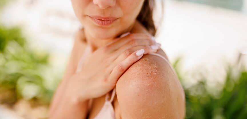 Trockene Haut Ekzem TCM