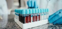 Blutbild Blutbefund Thrombozyten