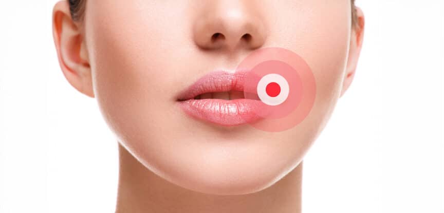 Herpes Viren Auslöser Stress Immunsystem