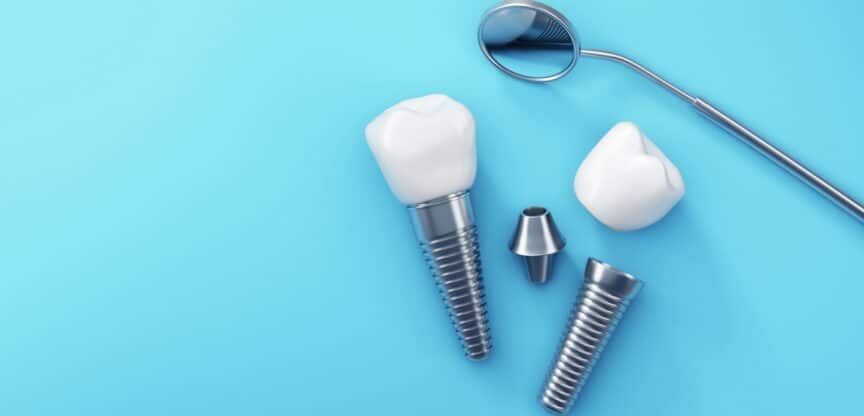 Implantat Mundgesundheit Zähne