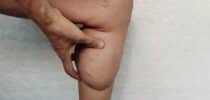 Lipödem Diagnose Selbsthilfegruppe