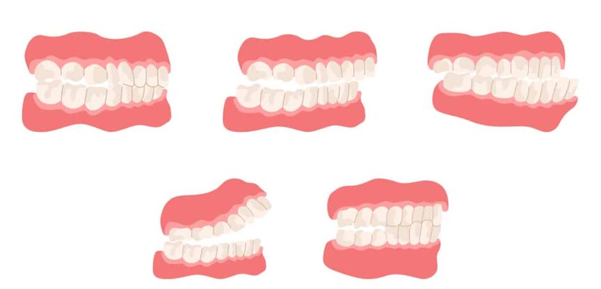 Zähne, Zahnfehlstellung