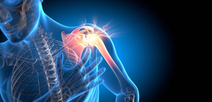 Gelenk, Bewegung, Schulter, Schulterluxation, Manschette