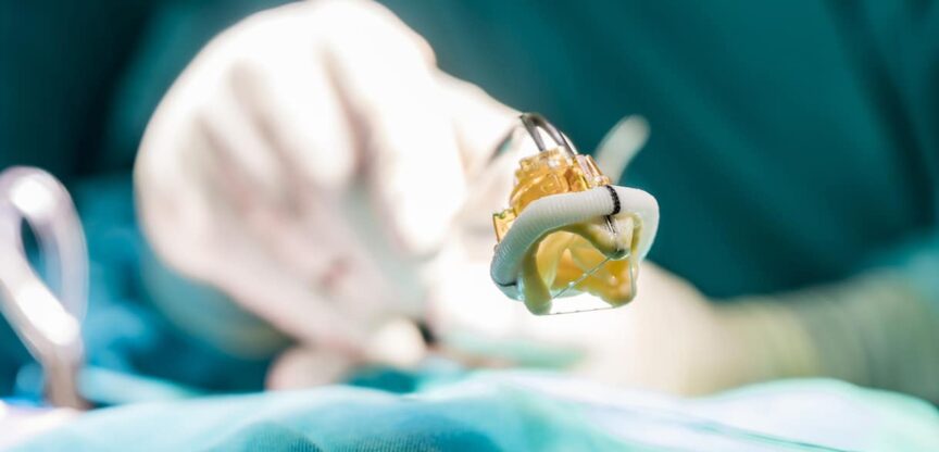 Herz, Bypass, Herzklappenersatz, Operation