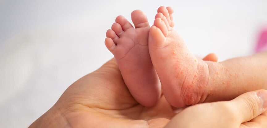 Haut, Neurodermitis, Juckreiz