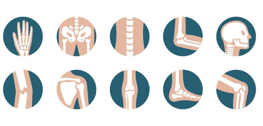 Knochen, Skelett, Osteoporose, Knochenschwund, Knochenbruch, Knochendichtemessung