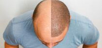 Schoenheitsoperation, Haartransplantation, Fut-Methode, Fue-Methode