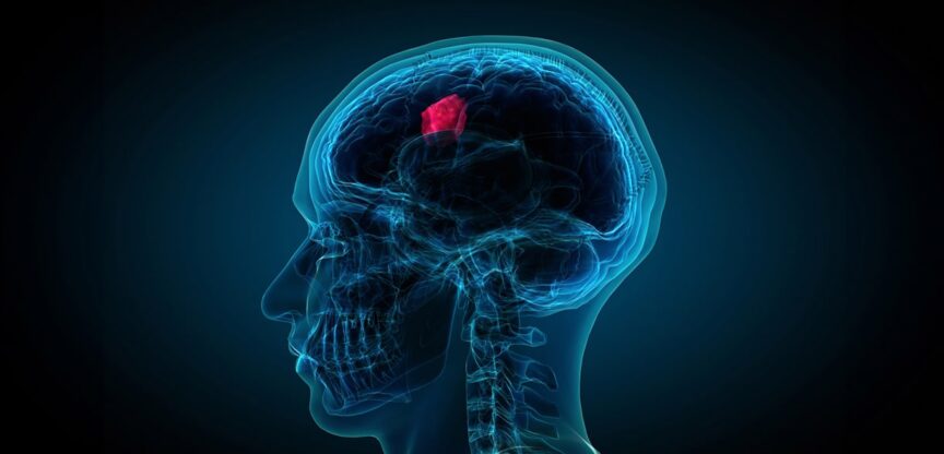Wach-Operation, Hirntumor, Operation, Gliome
