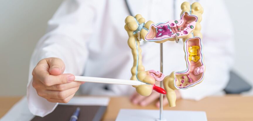 chronisch entzündlichen Darmerkrankungen, CED, Morbus Crohn, Colitis ulceros